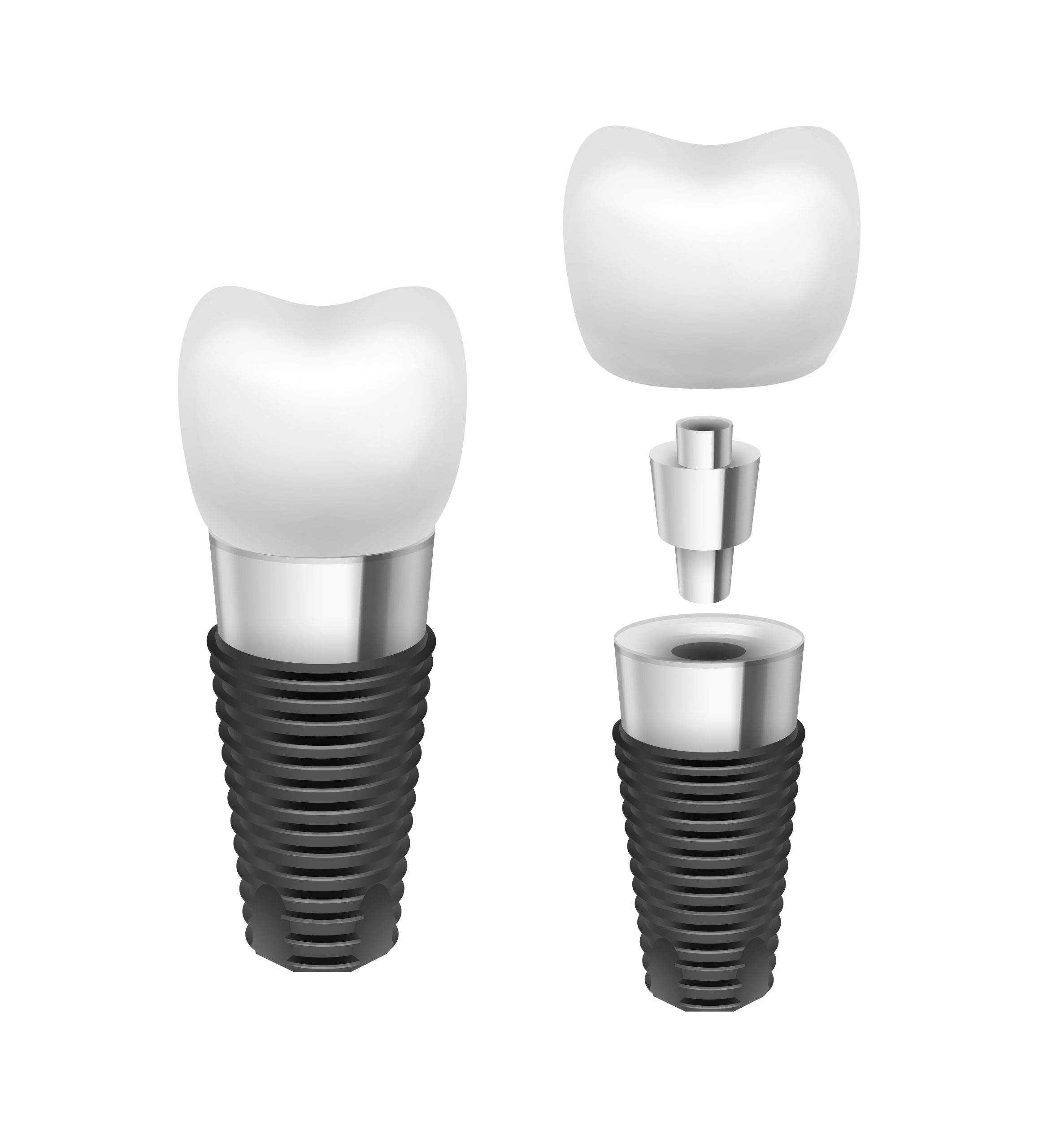 Trồng răng - Cấy ghép Implant