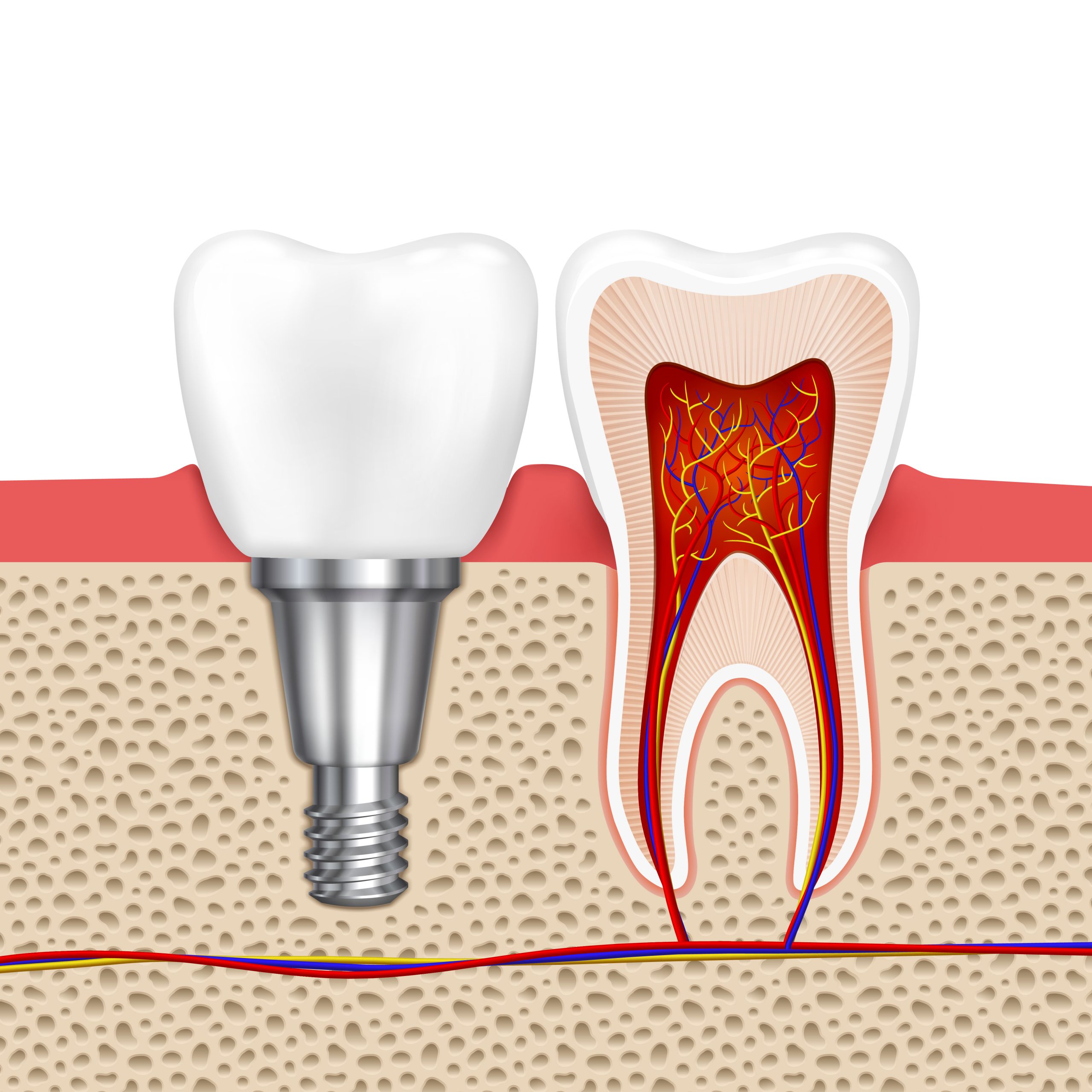 Trồng răng - Cấy ghép Implant