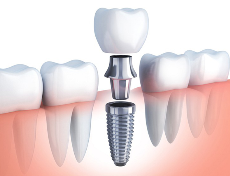 Cấy Ghép Implant